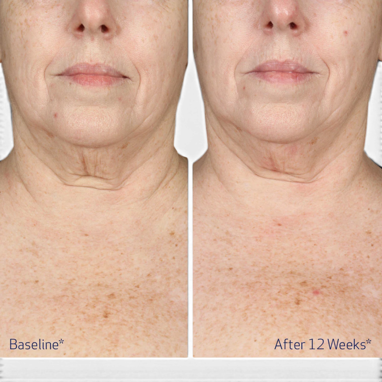Obagi Elastiderm® Neck and Décolleté Concentrate