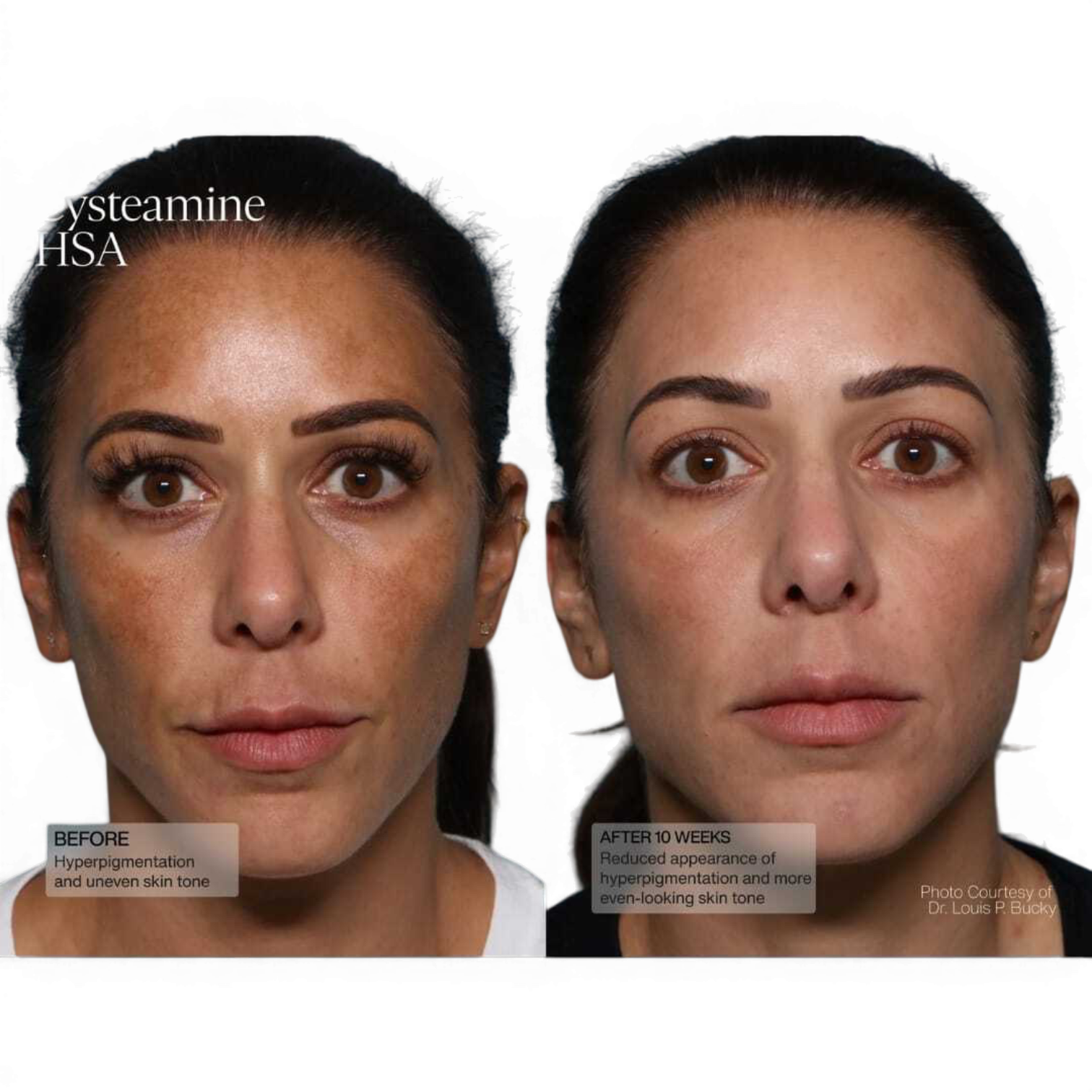 Senté® Pigment & Tone Correcting Mask, Cysteamine + HSA